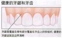治疗牙周病
