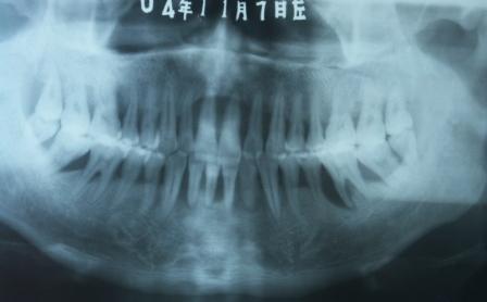牙周炎X线片