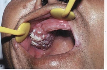 口腔及颌面部肿瘤