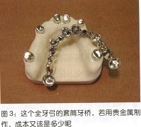 制做套筒冠的全新方法---套环技术