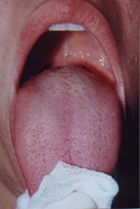 舌清洁方法