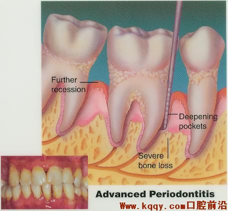 牙周病的示意图