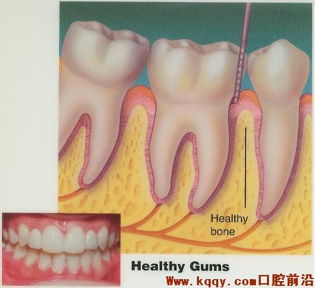 牙周病的示意图