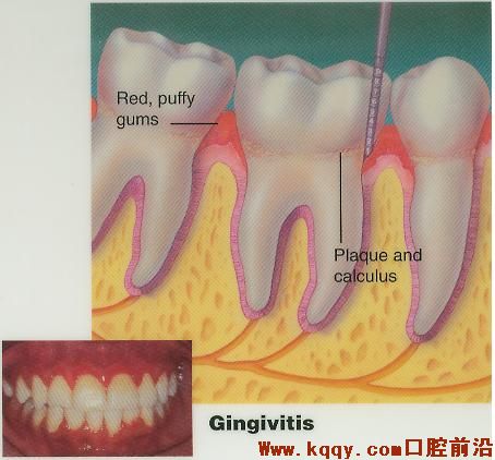 牙周病的示意图