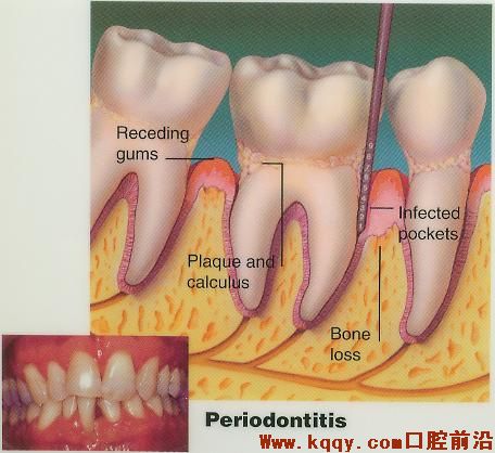 牙周病的示意图