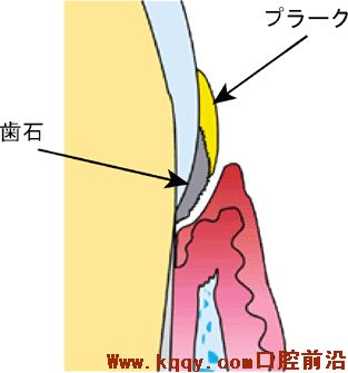 牙周病进展