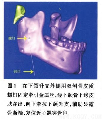 于下颌支外侧骨面充分分离,显露乙状切迹和骨断端后,置人乙状切迹拉钩